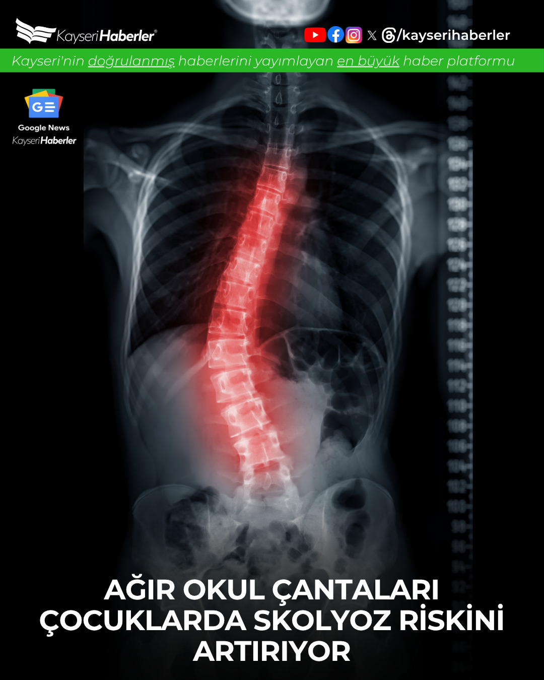 Uzmanından Okul Çağı Çocuklar İçin Skolyoz Uyarısı: Çanta Ağırlığına Dikkat!