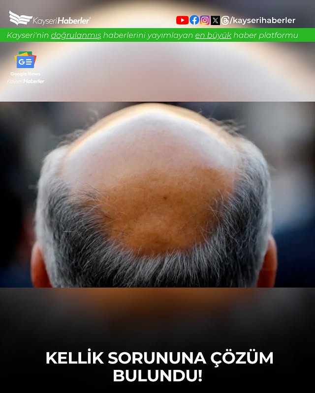 Japon Bilim İnsanlarından Kellik Tedavisi İçin Dev Adım: Saç Kökleri Laboratuvarda Yeniden Üretildi